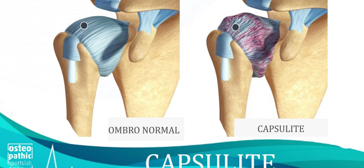 capsulite