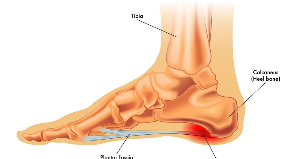 fascite-plantar